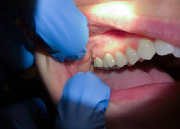 Best Dental Abscess Treatment in Lynbrook, NY